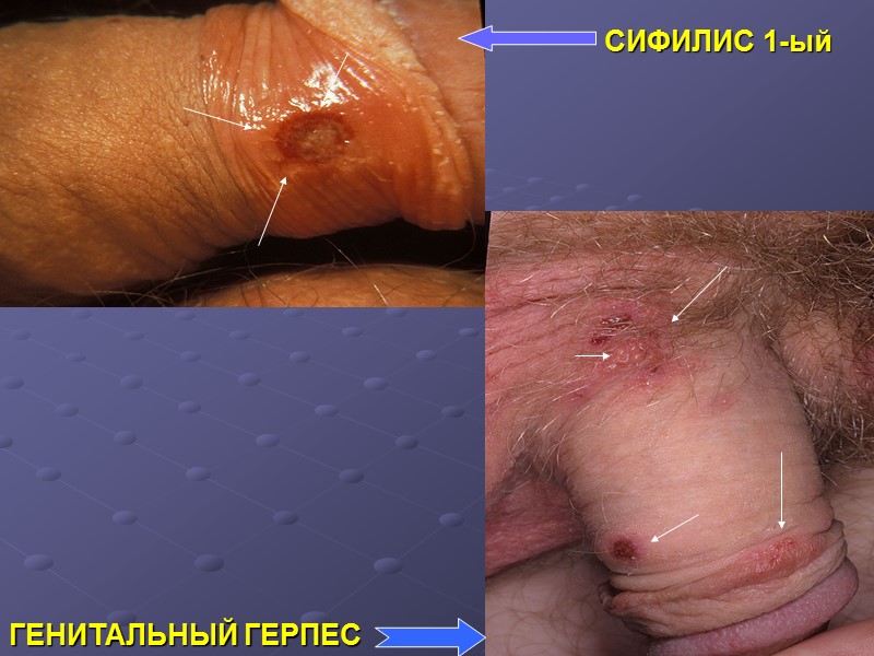 СИФИЛИС 1-ый ГЕНИТАЛЬНЫЙ ГЕРПЕС